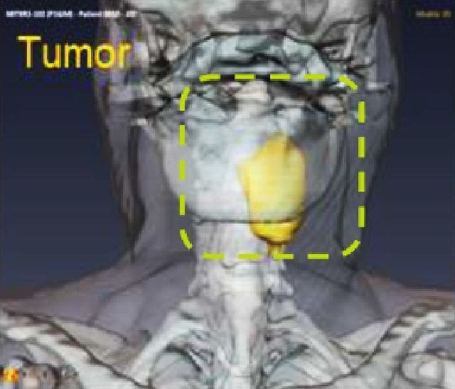 Post IT Injection